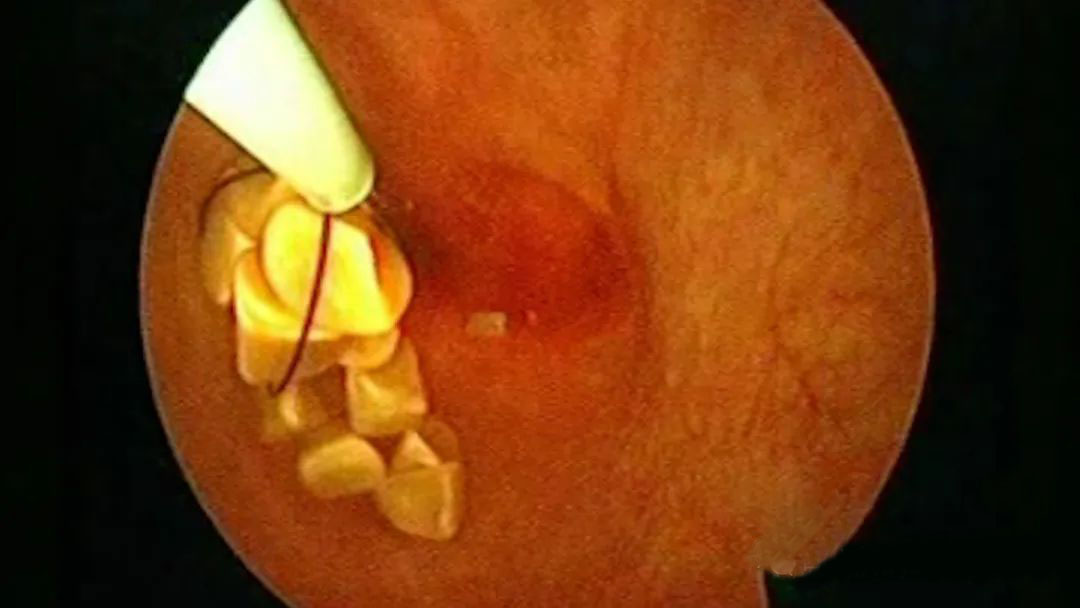 高光时刻!保胆取石专家、四川结石病医院何明刚主任亮相国内最高学术平台!(图4) 高光时刻!保胆取石专家、四川结石病医院何明刚主任亮相国内最高学术平台!(图4)