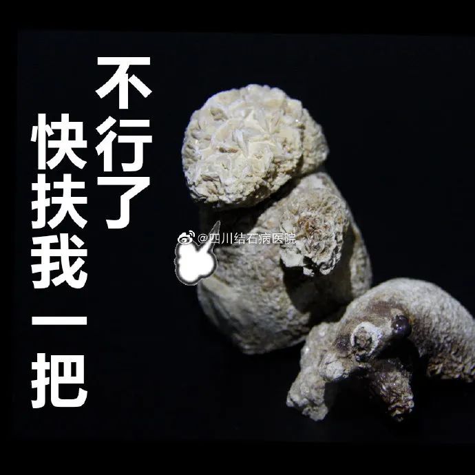 胆结石拖一拖无所谓?四川保胆取石专家:那是你没见识到它的“杀伤力”(图3) 胆结石拖一拖无所谓?四川保胆取石专家:那是你没见识到它的“杀伤力”(图3)