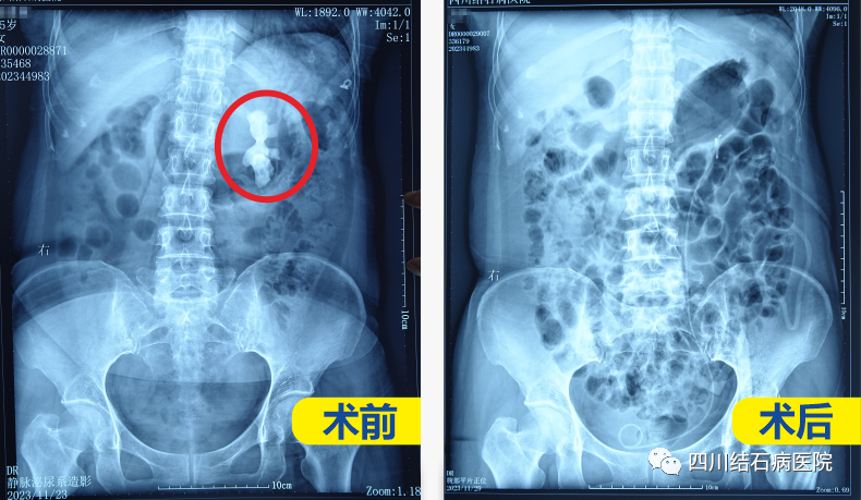 来了!医路奋进,2023年四川结石病医院大事记(图51) 来了!医路奋进,2023年四川结石病医院大事记(图51)