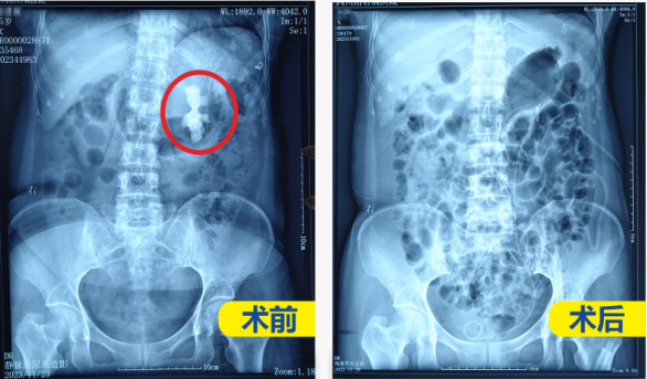 一次解决近7公分巨大结石,她说:常主任像第二个白求恩,希望他的医术名扬四海(图1) 一次解决近7公分巨大结石,她说:常主任像第二个白求恩,希望他的医术名扬四海(图1)