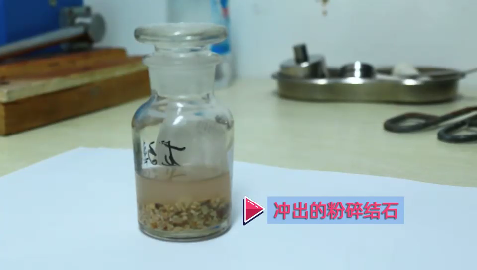 一次解决近7公分巨大结石,她说:常主任像第二个白求恩,希望他的医术名扬四海(图3) 一次解决近7公分巨大结石,她说:常主任像第二个白求恩,希望他的医术名扬四海(图3)