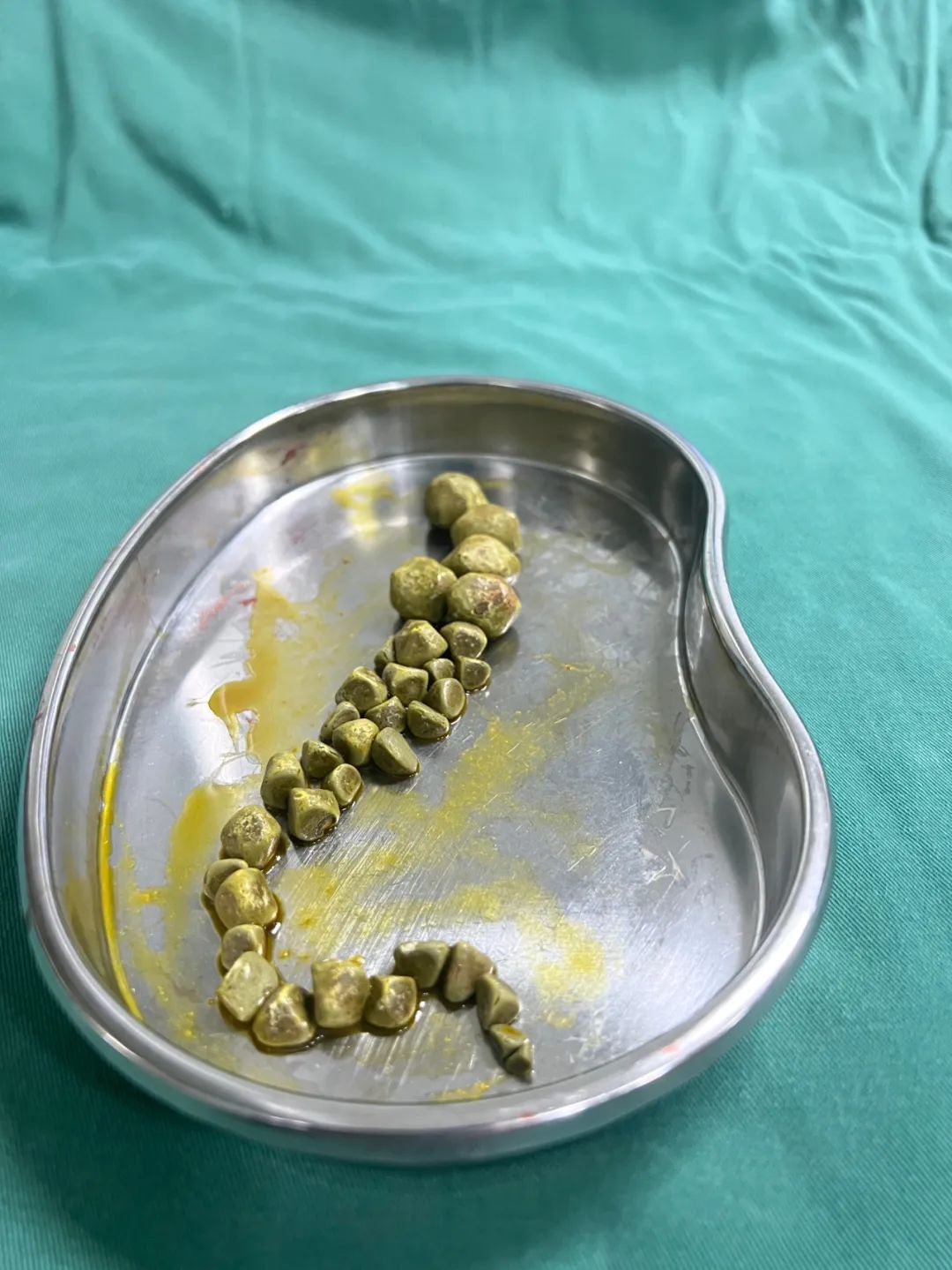 注意了!四川结石病医院提醒:节后这类疾病正在持续高发中!(图2) 注意了!四川结石病医院提醒:节后这类疾病正在持续高发中!(图2)