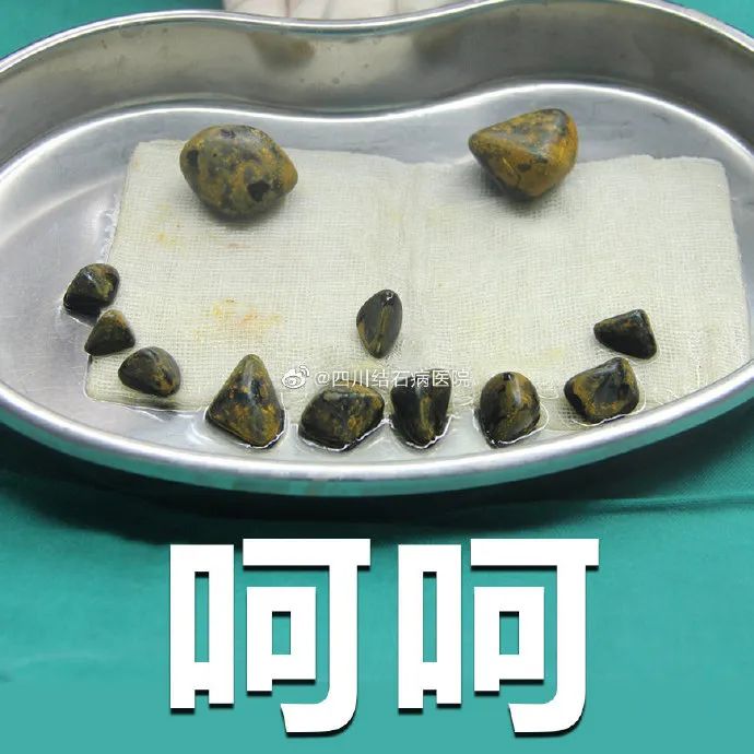 注意了!四川结石病医院提醒:节后这类疾病正在持续高发中!(图4) 注意了!四川结石病医院提醒:节后这类疾病正在持续高发中!(图4)