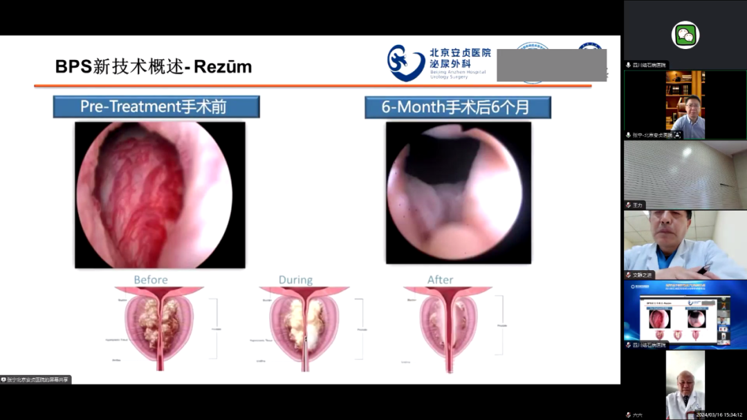 四川结石病医院召开瑞梦前列腺热蒸汽消融手术完成100例学术报告会(图11) 四川结石病医院召开瑞梦前列腺热蒸汽消融手术完成100例学术报告会(图11)