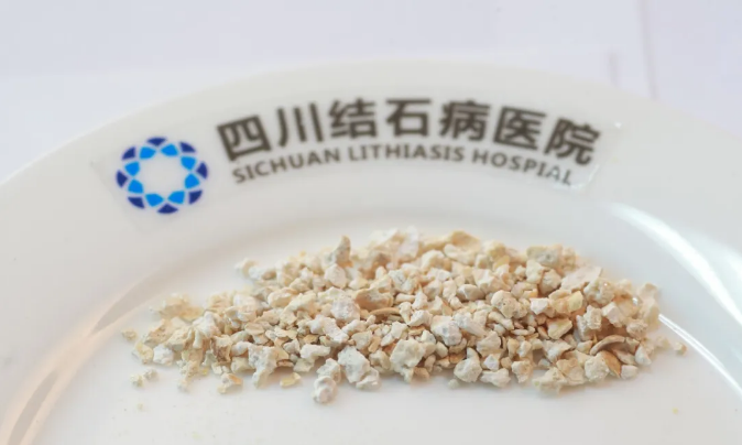 成都碎石医院:做了体外碎石居然没碎干净?真相到底是什么?(图1) 成都碎石医院:做了体外碎石居然没碎干净?真相到底是什么?(图1)