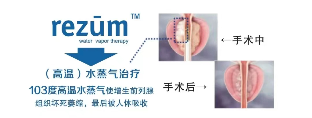 四川瑞梦热蒸汽消融术适用人群及优势分析，快来了解一下！(图2)