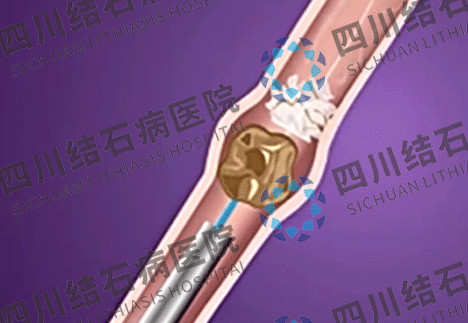 成都碎石大概多少钱？成都医院碎石收费标准【成都24小时接诊医院】(图2)