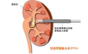 成都碎石大概多少钱？成都医院碎石收费标准【成都24小时接诊医院】(图3)