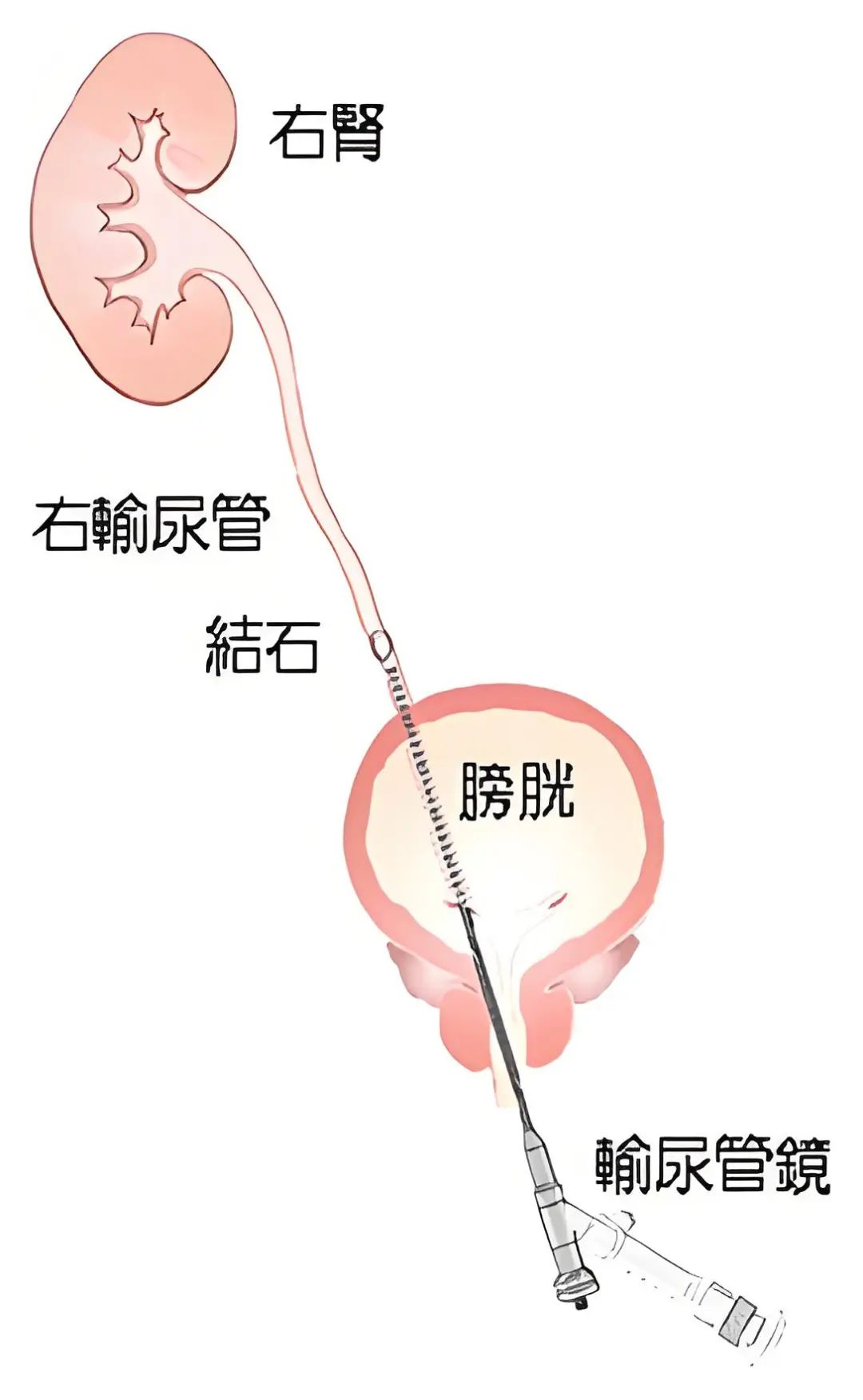 患者关注：肾结石术后多久能恢复？从手术区别到恢复周期，一篇讲明白！【四川结石病专科医院】(图2)