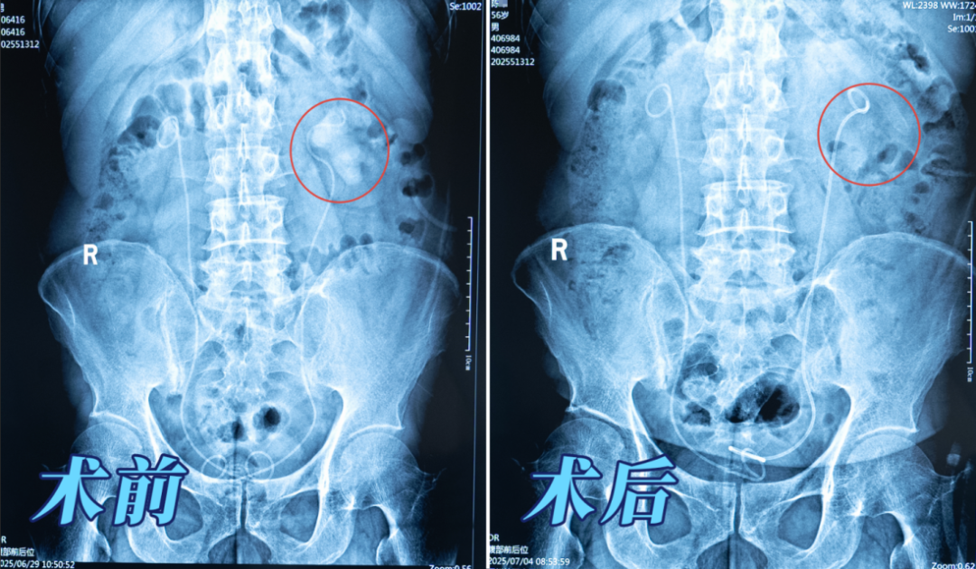 案例分享:又见“巨无霸”!男子肾脏取出8公分铸型结石【四川肾结石专科医院】(图1) 案例分享:又见“巨无霸”!男子肾脏取出8公分铸型结石【四川肾结石专科医院】(图1)