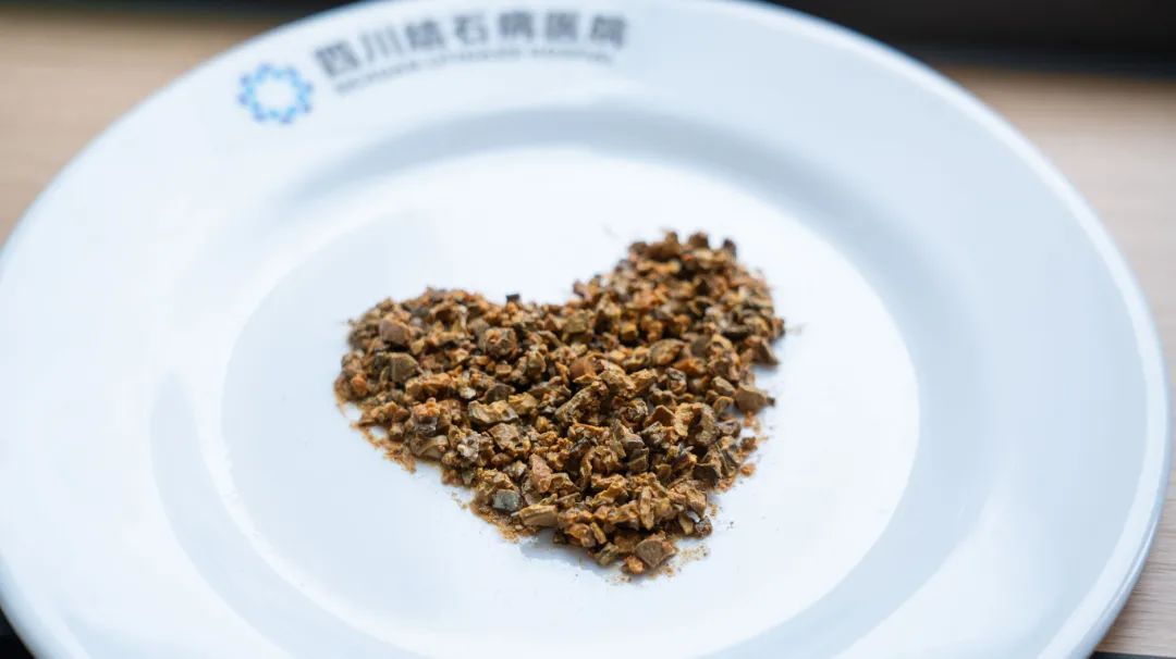 案例分享:又见“巨无霸”!男子肾脏取出8公分铸型结石【四川肾结石专科医院】(图4) 案例分享:又见“巨无霸”!男子肾脏取出8公分铸型结石【四川肾结石专科医院】(图4)