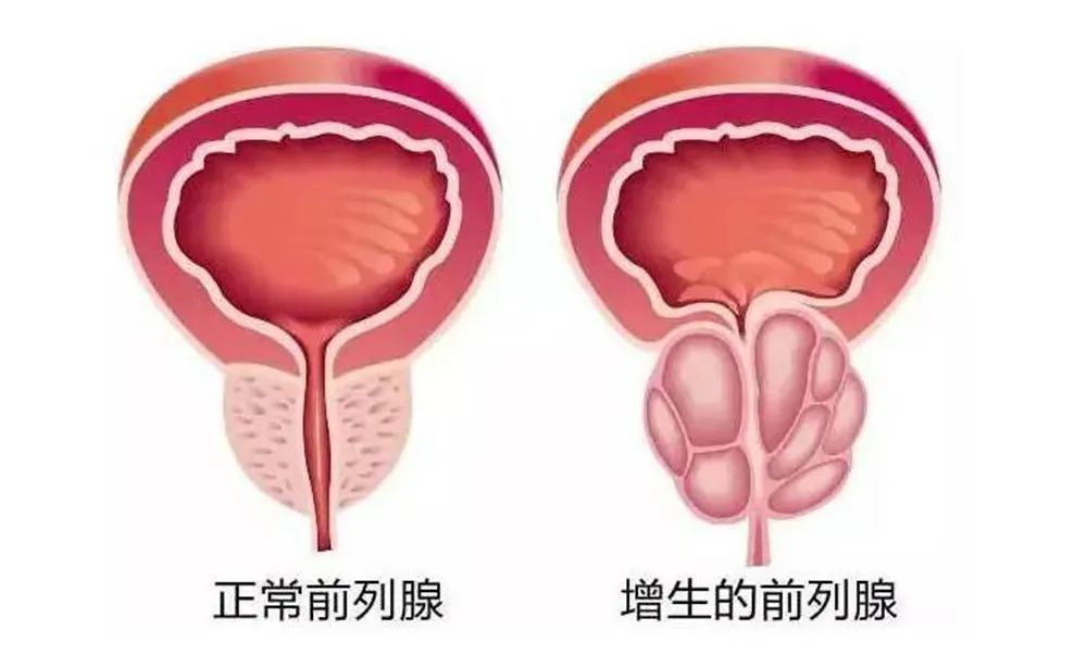 瑞梦热蒸汽消融术——前列腺增生“黑科技” 3分钟化解“急”尿尴尬(图2)