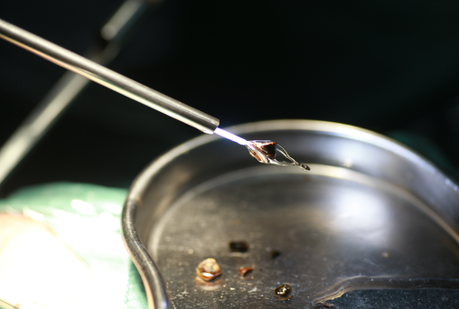 四川肾结石医院孙剑鸿主任详解:体外碎石并非万能,次数超限恐伤肾【成都24小时碎石医院】(图4) 四川肾结石医院孙剑鸿主任详解:体外碎石并非万能,次数超限恐伤肾【成都24小时碎石医院】(图4)