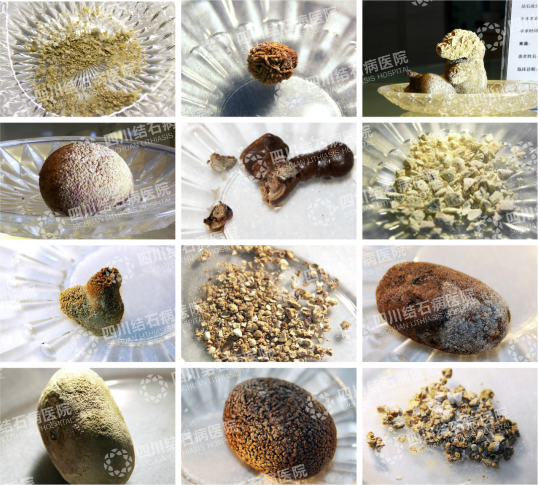 肾结石快速排出指南：科学方法助力结石排出【成都24小时碎石医院】(图7)