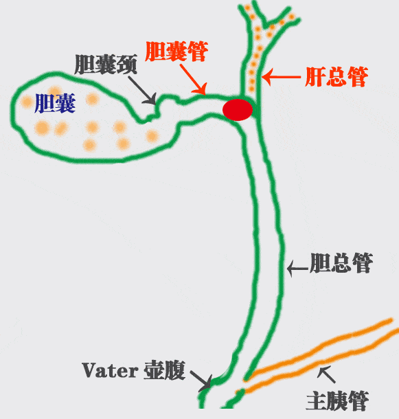 胆囊结石能吃药排石吗？吃药有影响吗？听听专家怎么说【四川胆结石专科医院】(图2)