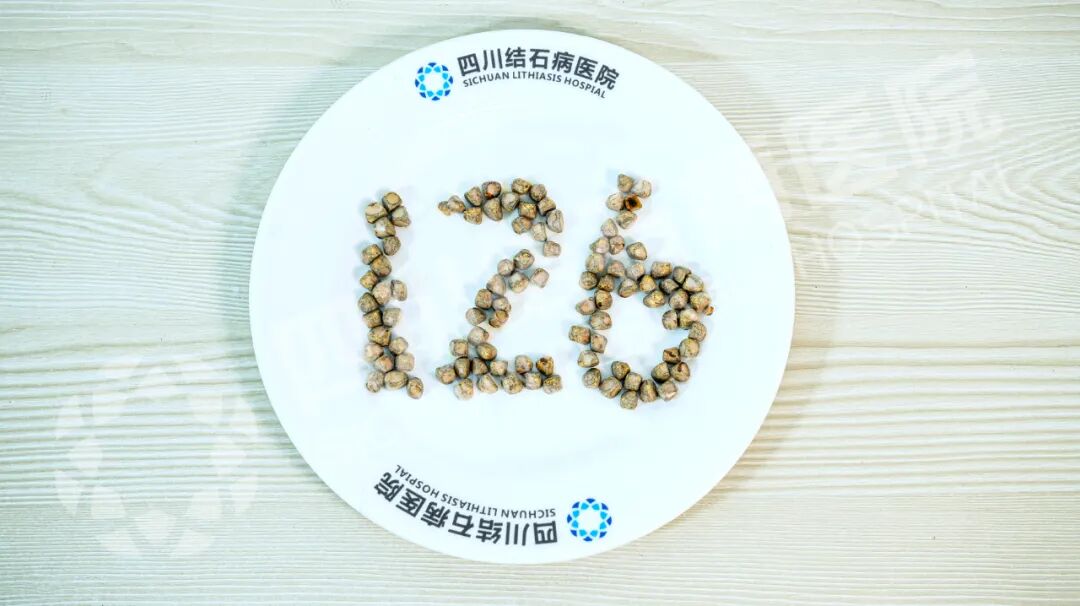 126颗结石藏胆囊！杭州男子赴川保胆手术登热搜，这些风险别忽视(图2)