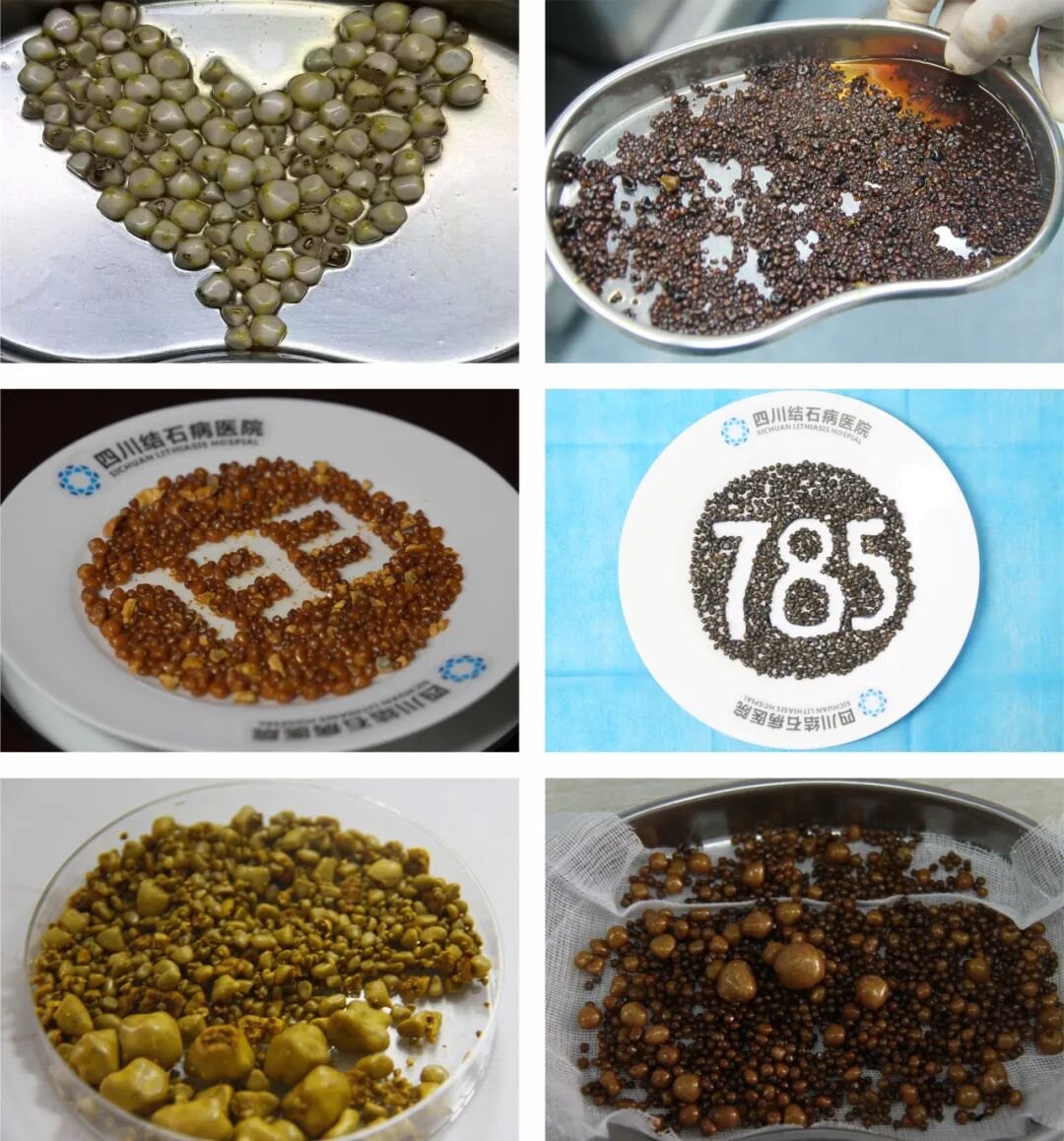 126颗结石藏胆囊！杭州男子赴川保胆手术登热搜，这些风险别忽视(图5)
