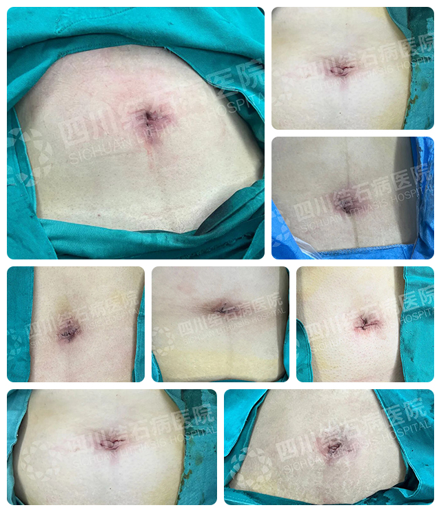 保胆取石、疤痕隐形、恢复更快：快来了解下保胆届的“六边形技术”！(图3)