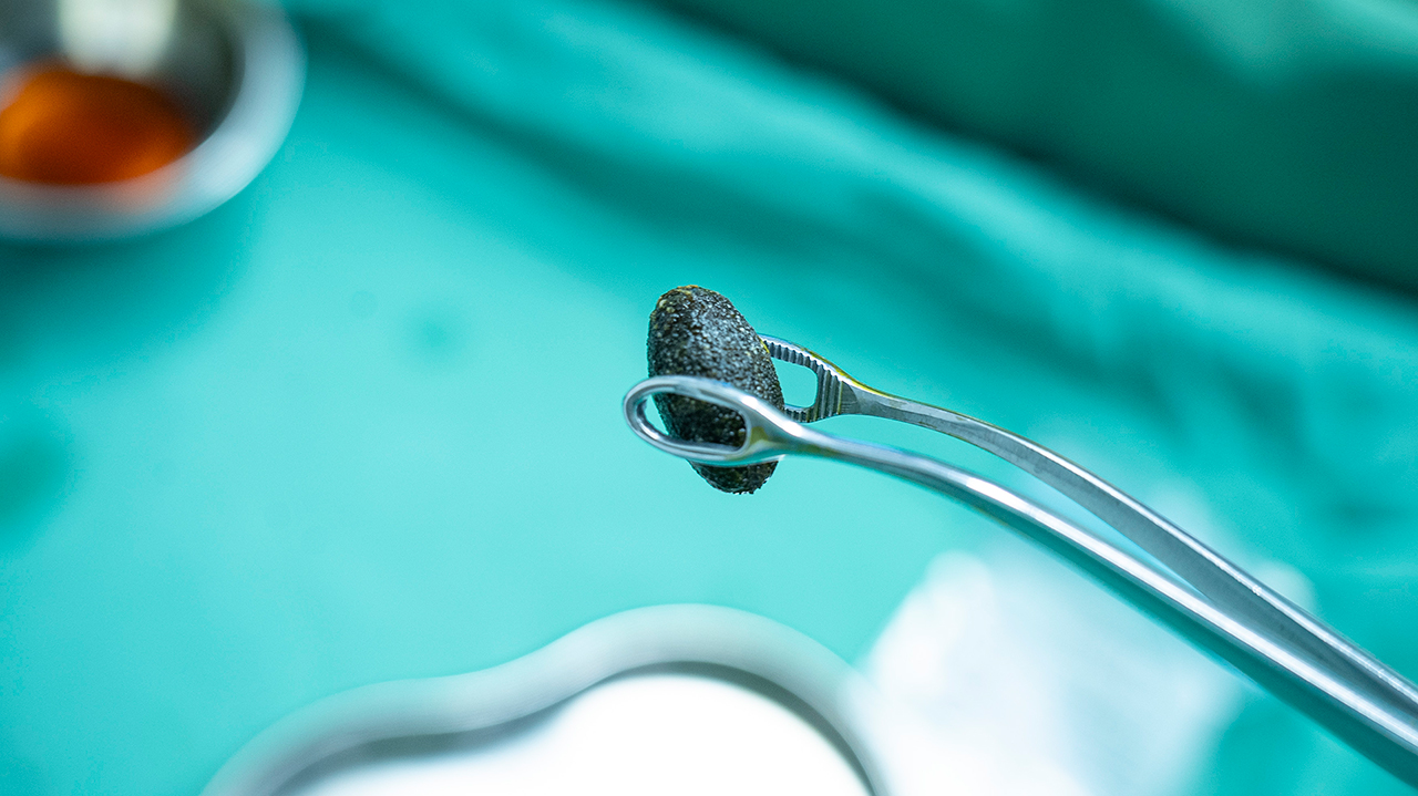 为“保胆”而来：北京国之名医刘京山教授再度来院，亲诊手术惠泽西南患者(图6)