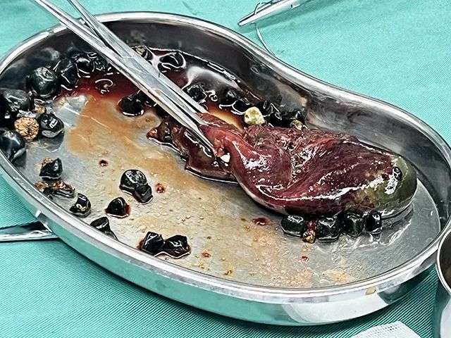 结石不痛=安全?大错特错!何明刚主任揭穿胆囊结石的“伪装”(图2) 结石不痛=安全?大错特错!何明刚主任揭穿胆囊结石的“伪装”(图2)