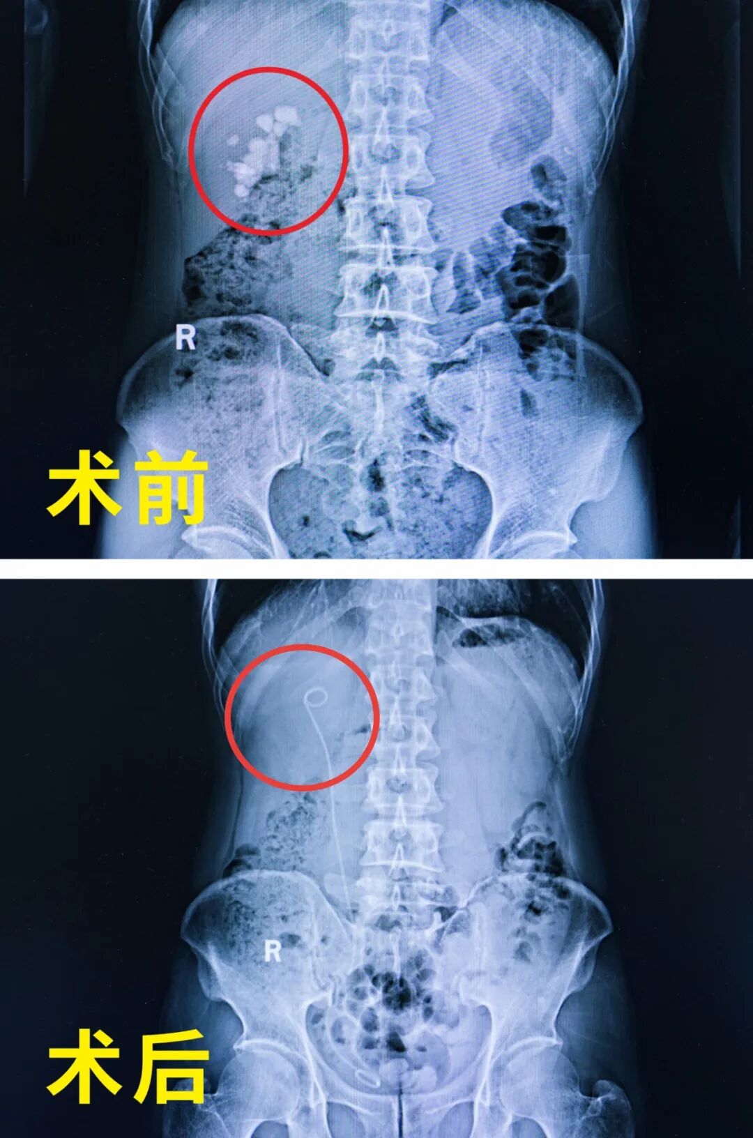 肾里揣着“鹌鹑蛋”,手术排队一个月?我院为治疗按下“加速键”(图3) 肾里揣着“鹌鹑蛋”,手术排队一个月?我院为治疗按下“加速键”(图3)