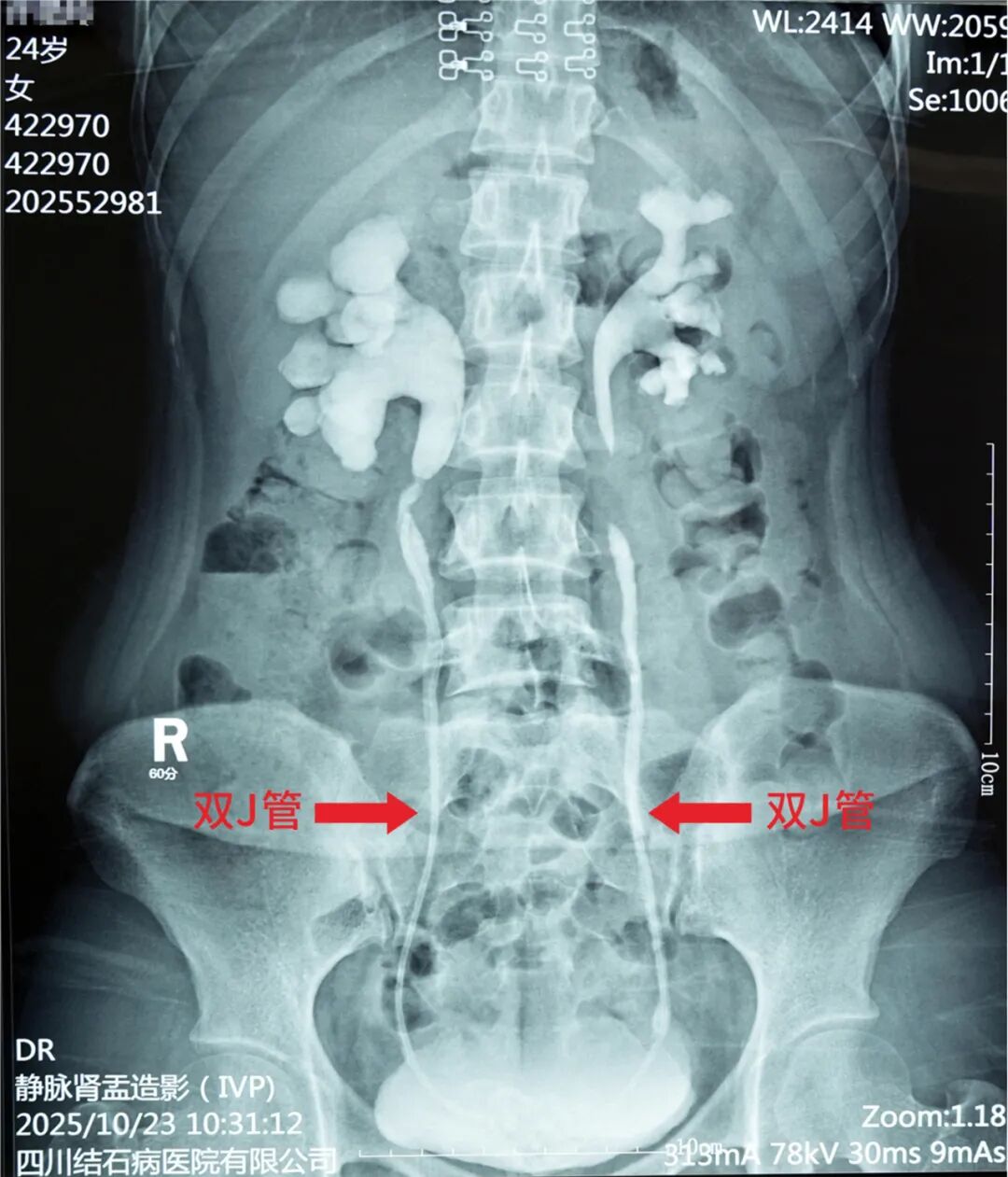 24岁女子双肾功能受损!原因竟是她将这个忘在了身体里……【四川结石病医院】(图1) 24岁女子双肾功能受损!原因竟是她将这个忘在了身体里……【四川结石病医院】(图1)