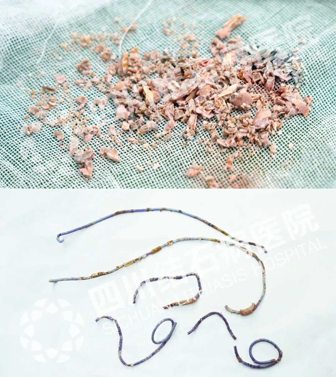 24岁女子双肾功能受损!原因竟是她将这个忘在了身体里……【四川结石病医院】(图4) 24岁女子双肾功能受损!原因竟是她将这个忘在了身体里……【四川结石病医院】(图4)