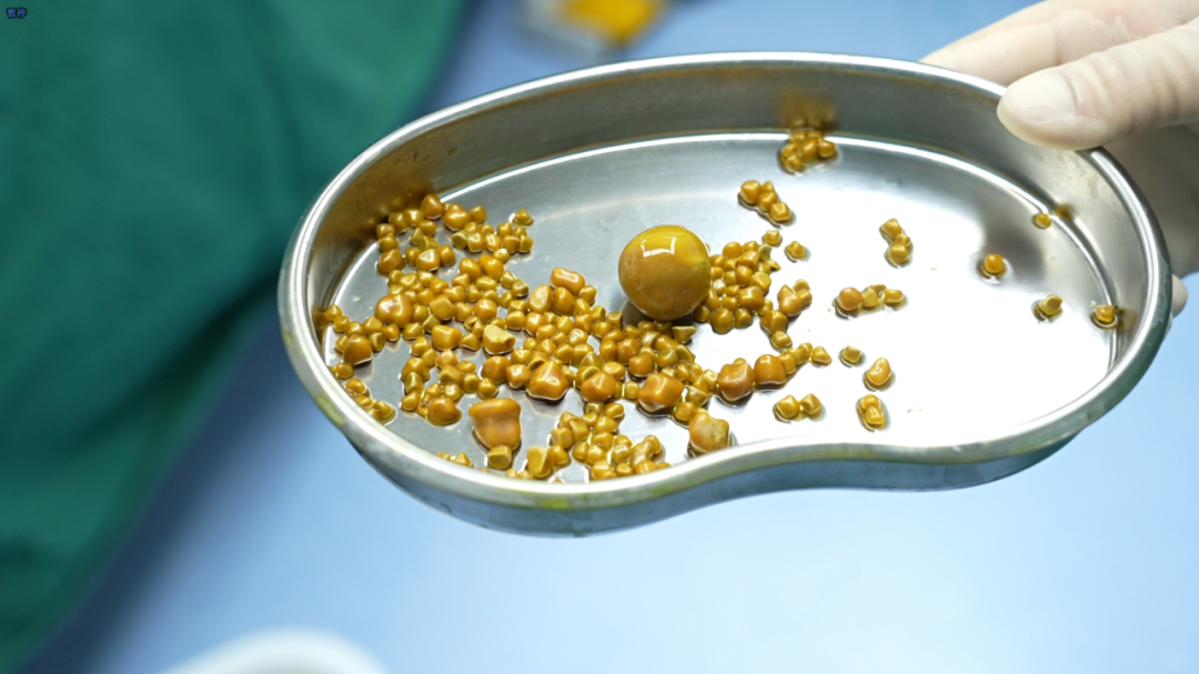 2025年度|四川结石病医院肝胆外科:深耕亚专科,绘就精准医疗蓝图(图4) 2025年度|四川结石病医院肝胆外科:深耕亚专科,绘就精准医疗蓝图(图4)