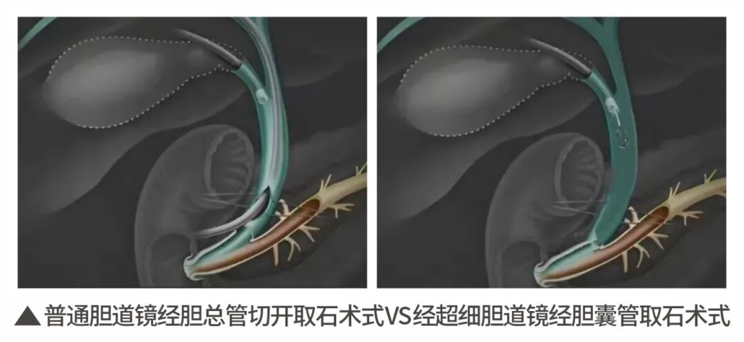 2025年度|四川结石病医院肝胆外科:深耕亚专科,绘就精准医疗蓝图(图13) 2025年度|四川结石病医院肝胆外科:深耕亚专科,绘就精准医疗蓝图(图13)