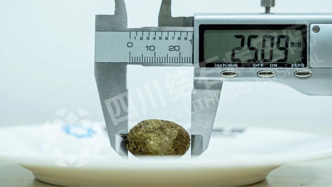 奔波求医路:广元大姐专程来蓉保胆,取出“皮蛋”状结石【四川保胆取石医院】(图1) 奔波求医路:广元大姐专程来蓉保胆,取出“皮蛋”状结石【四川保胆取石医院】(图1)