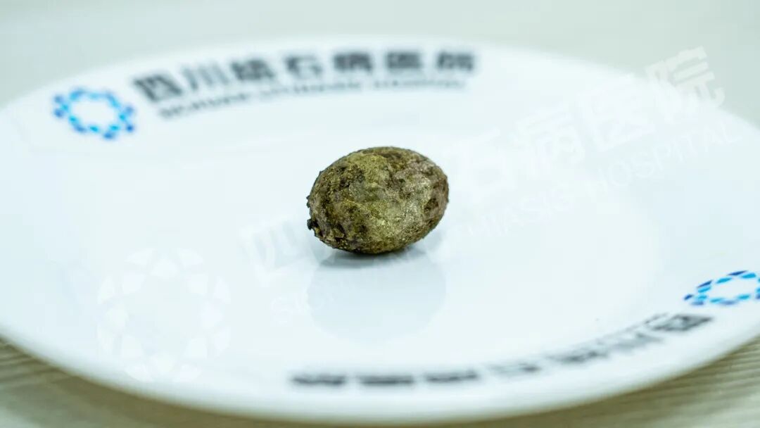 奔波求医路:广元大姐专程来蓉保胆,取出“皮蛋”状结石【四川保胆取石医院】(图3) 奔波求医路:广元大姐专程来蓉保胆,取出“皮蛋”状结石【四川保胆取石医院】(图3)