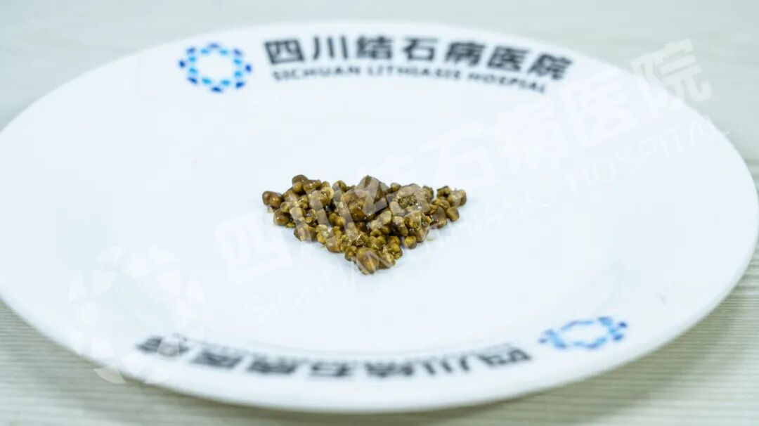 腹部不适不重视,一顿腊肉香肠把她送进医院【四川胆结石专科医院】(图2) 腹部不适不重视,一顿腊肉香肠把她送进医院【四川胆结石专科医院】(图2)