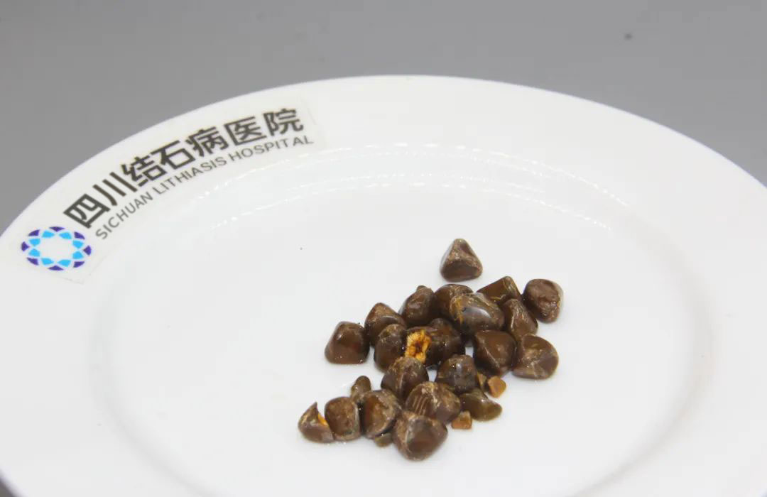 春节护胆指南 | 胆结石患者牢记 “3做3不做”，安心团圆不添忧(图4)