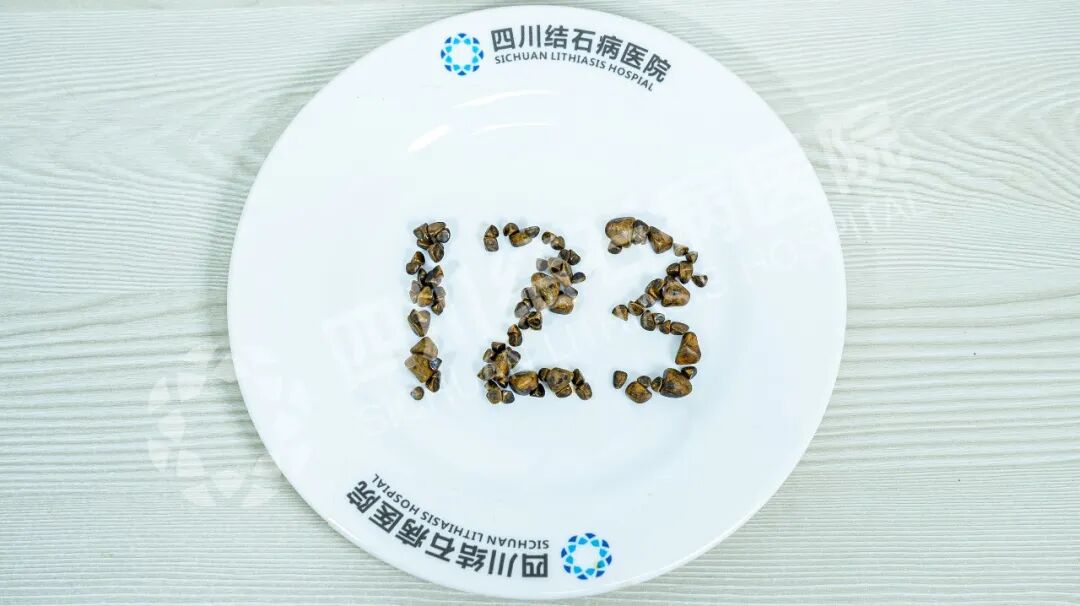 保胆取出123颗!盲目吃药为何成结石“帮凶”?【四川胆结石医院】(图1) 保胆取出123颗!盲目吃药为何成结石“帮凶”?【四川胆结石医院】(图1)