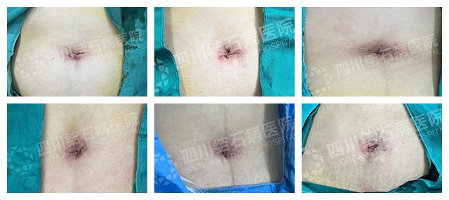 胆结石不痛，为啥还要手术？背后真相很多人不知道 | 四川结石病医院(图5)