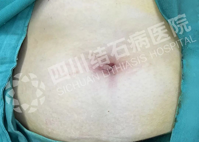 【全国肿瘤防治宣传周】走进双流，我院义诊为百姓胆囊健康“排雷”(图10)