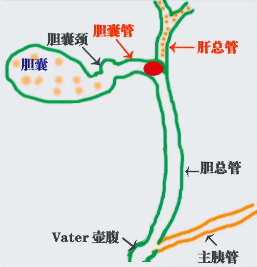 胆囊结石科学处理指南:无症状期,为什么首推“保胆取石”?(图1) 胆囊结石科学处理指南:无症状期,为什么首推“保胆取石”?(图1)