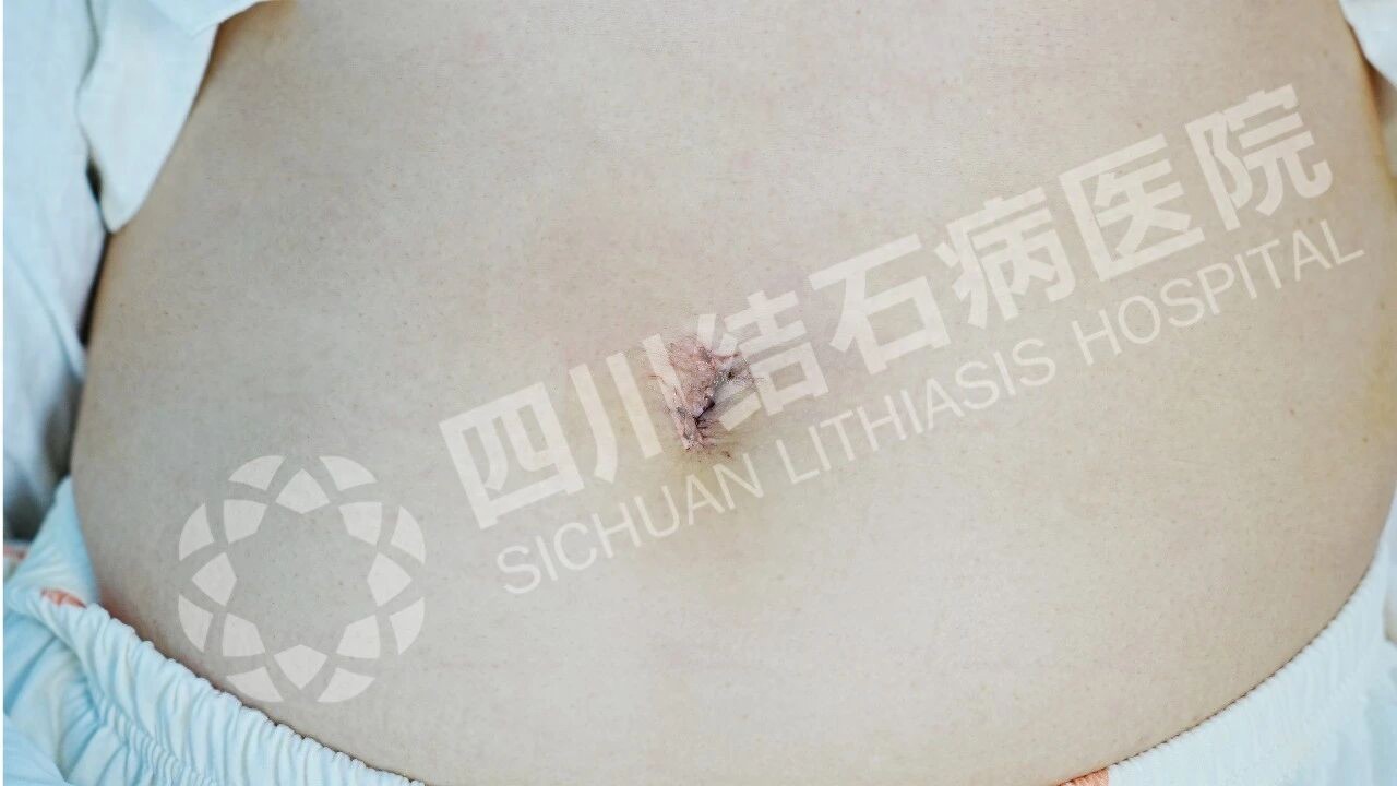 胆囊结石科学处理指南:无症状期,为什么首推“保胆取石”?(图5) 胆囊结石科学处理指南:无症状期,为什么首推“保胆取石”?(图5)