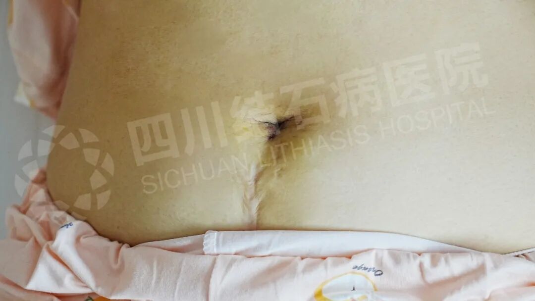 夫妻“接力”来院：同一个专家，更先进的“隐痕保胆”技术(图1)