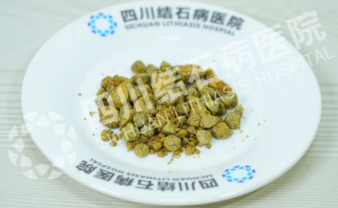 又一大盘结石,成功保胆!四川保胆取石医院(图1) 又一大盘结石,成功保胆!四川保胆取石医院(图1)