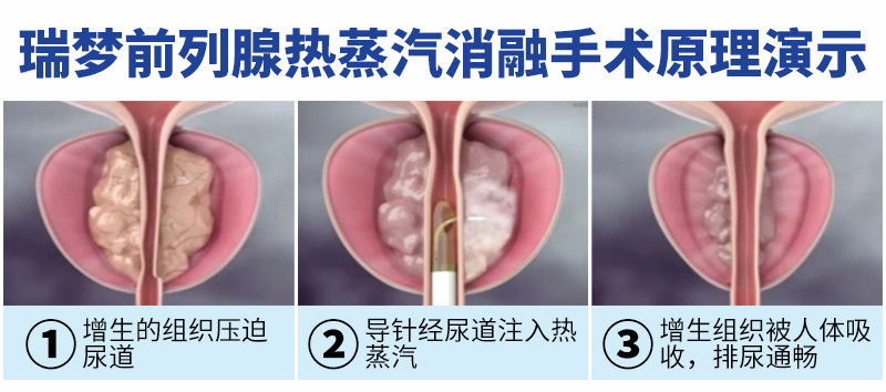 别让前列腺“男”题，成为说不出口的秘密【四川瑞梦热蒸汽消融医院】(图3)