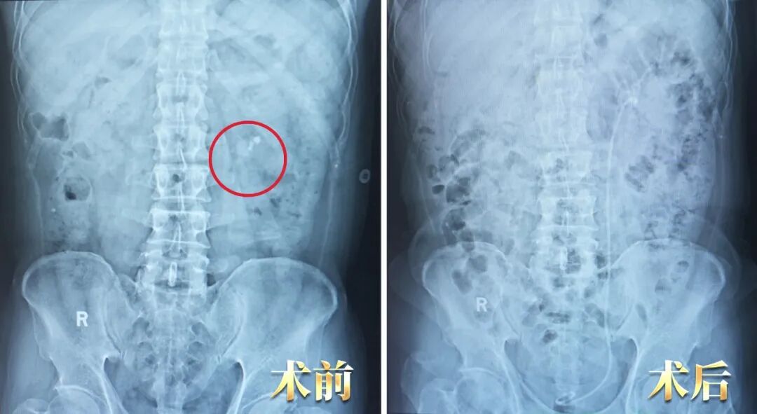 一面锦旗,十年信任:结石体质患者的两次选择【四川肾结石医院】(图2) 一面锦旗,十年信任:结石体质患者的两次选择【四川肾结石医院】(图2)