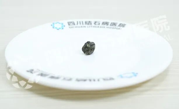 从“大山压胸”到一身轻松,他连连点赞“保胆”!【四川保胆取石医院】(图1) 从“大山压胸”到一身轻松,他连连点赞“保胆”!【四川保胆取石医院】(图1)