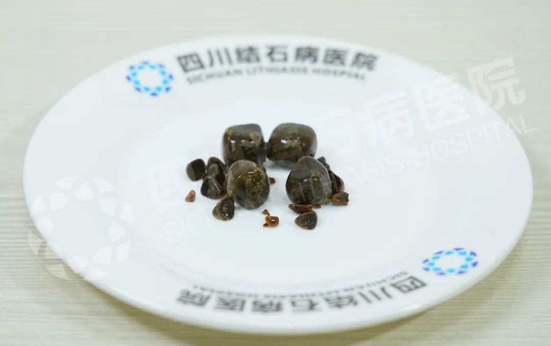 新疆患者千里来院 赴与国之名医刘京山教授的“保胆之约”(图1) 新疆患者千里来院 赴与国之名医刘京山教授的“保胆之约”(图1)