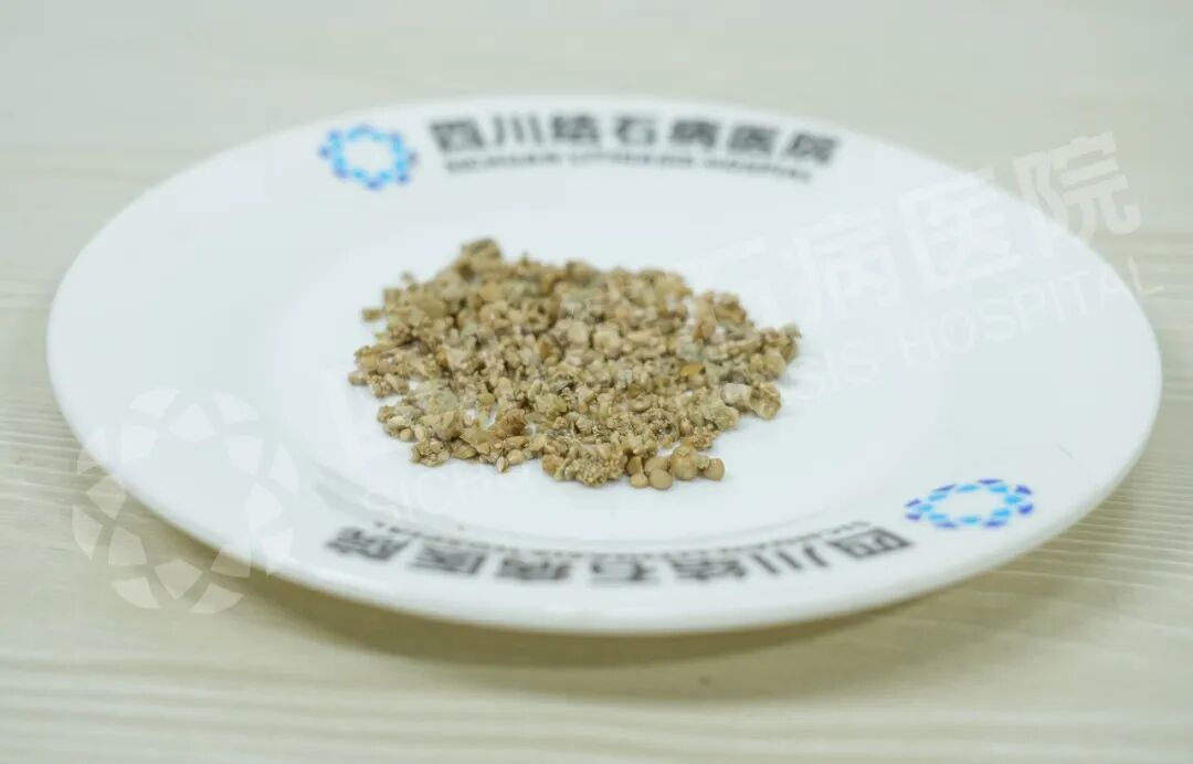 又一颗复杂「鹿角形铸型结石」,四川结石病医院专家一次性“清剿”!(图1) 又一颗复杂「鹿角形铸型结石」,四川结石病医院专家一次性“清剿”!(图1)