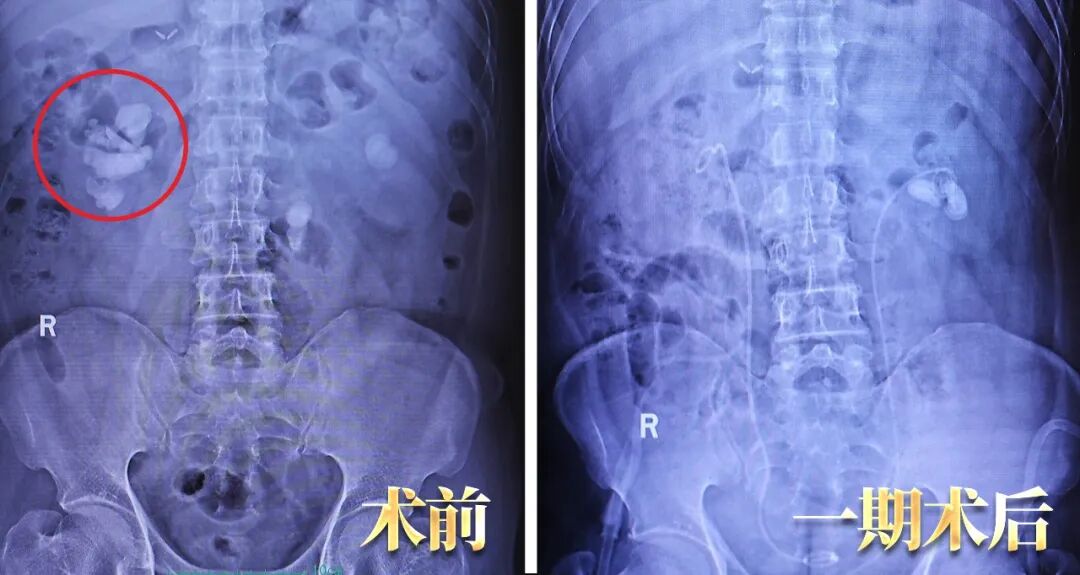 又一颗复杂「鹿角形铸型结石」,四川结石病医院专家一次性“清剿”!(图2) 又一颗复杂「鹿角形铸型结石」,四川结石病医院专家一次性“清剿”!(图2)