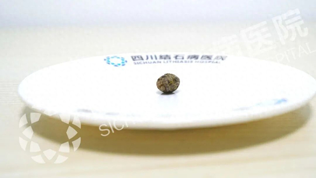 不用带T管!无管化手术实现快速康复【四川保胆取石】(图1) 不用带T管!无管化手术实现快速康复【四川保胆取石】(图1)