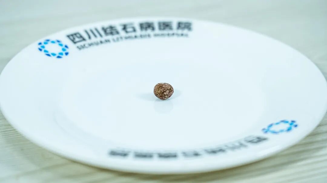 痛心!小小结石嵌顿胆管,遗憾切胆【四川胆结石专科医院】(图1) 痛心!小小结石嵌顿胆管,遗憾切胆【四川胆结石专科医院】(图1)