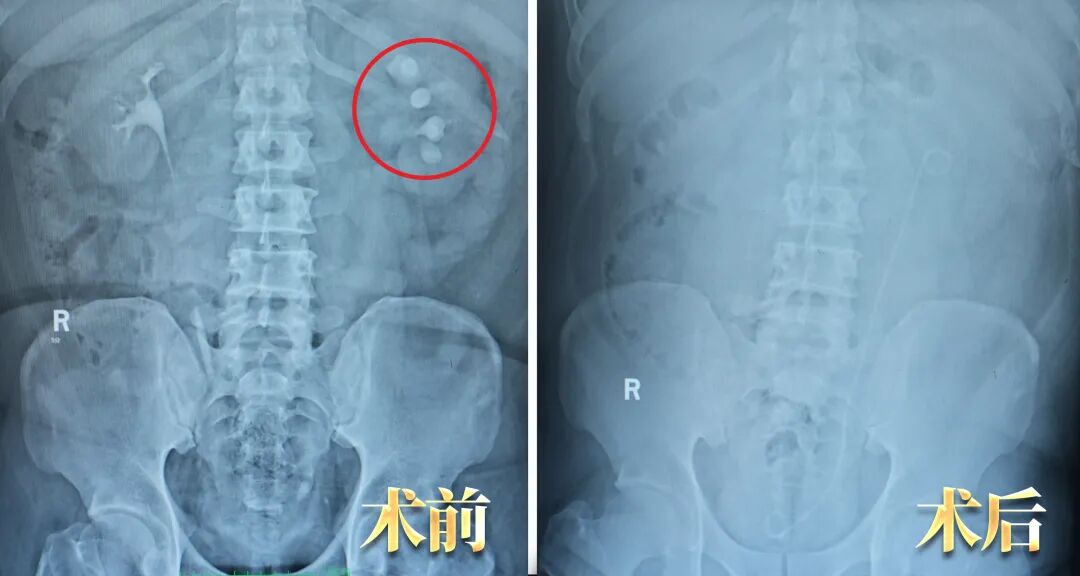 案例分享：反复“尿路感染”一年治不好？真凶竟是它！【四川结石病医院】(图1)