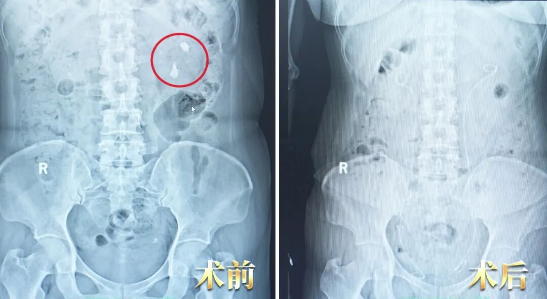 她一句“再等等”“还能忍”,差点毁掉一个肾!【四川肾结石医院】(图1) 她一句“再等等”“还能忍”,差点毁掉一个肾!【四川肾结石医院】(图1)